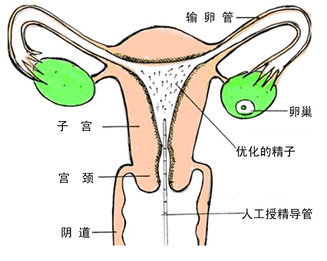 人工受精 人工受精