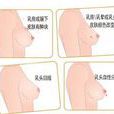乳房脂肪瘤 乳房脂肪瘤