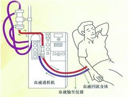 人工肾 人工肾