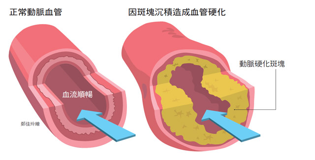 低密度胆固醇 低密度胆固醇