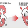 胎儿双肾积水