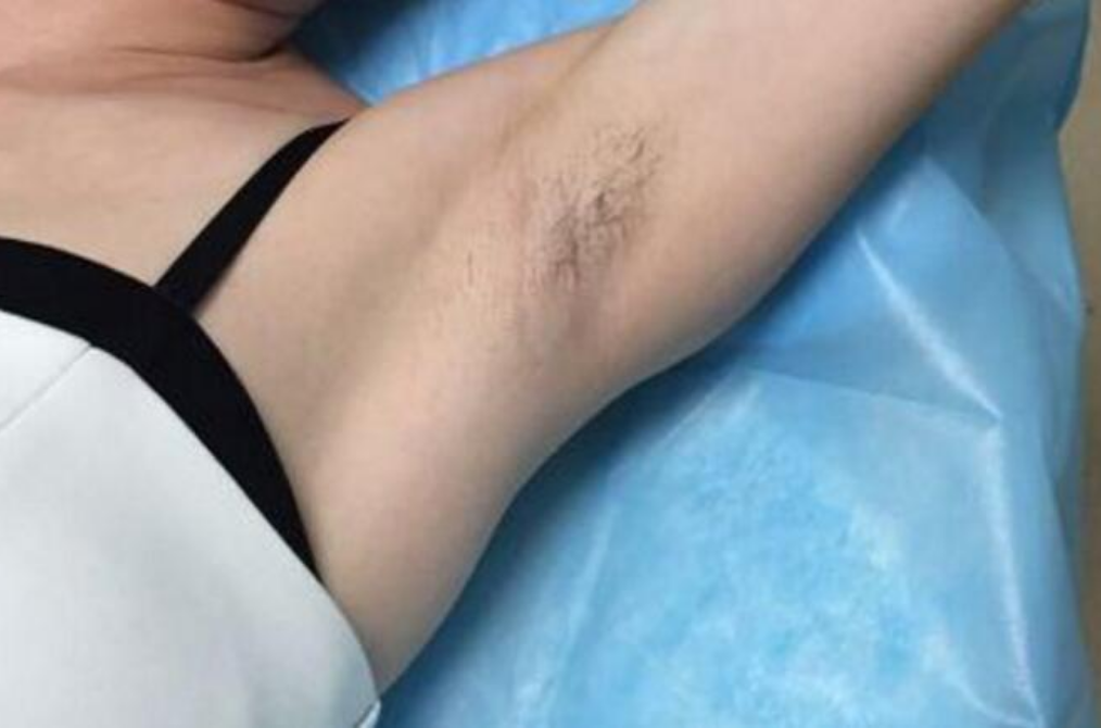 腋毛