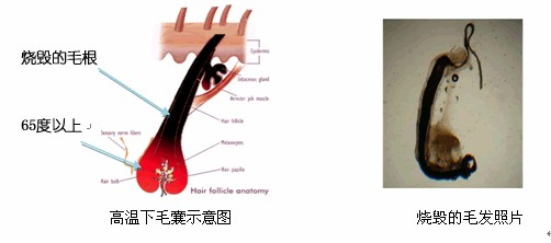 冰点脱毛 冰点脱毛
