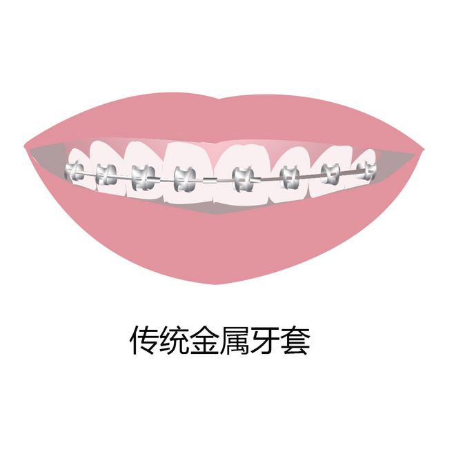 金属牙套