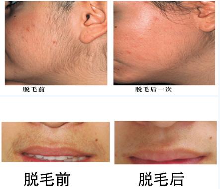 冰点脱毛 冰点脱毛