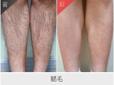 冰点脱毛 冰点脱毛