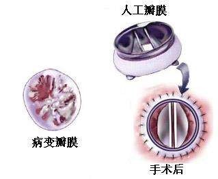 人工瓣膜 人工瓣膜