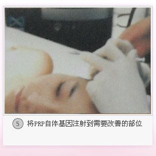 PRP抗衰焕颜