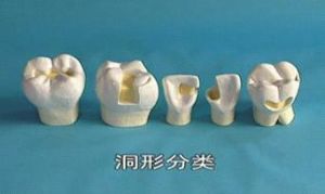 窝洞充填术