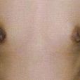 乳腺发育不良