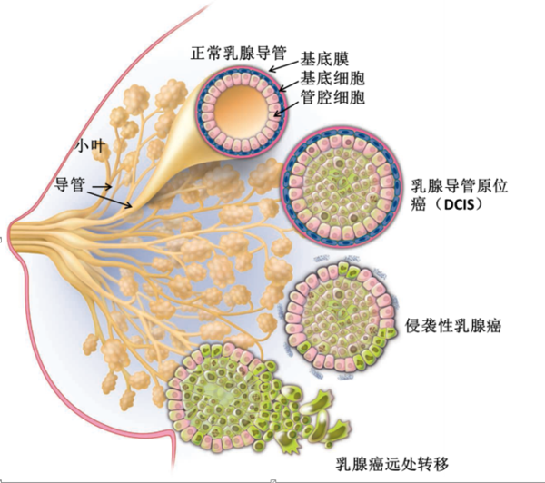乳腺导管内原位癌