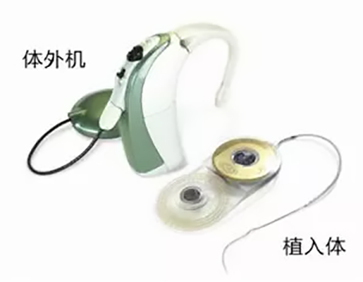 人工耳蜗 人工耳蜗