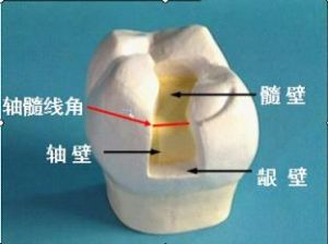 窝洞充填术