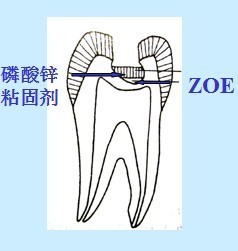 窝洞充填术