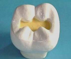 窝洞充填术