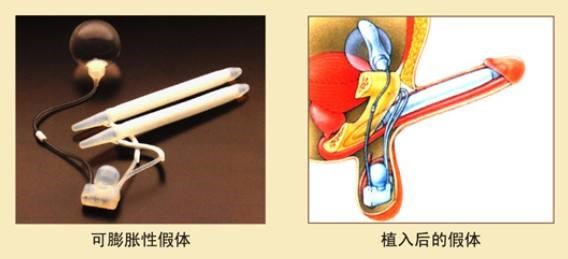 阴茎假体 阴茎假体