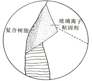 窝洞充填术