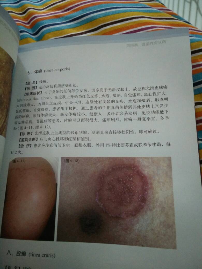 铜钱癣 铜钱癣