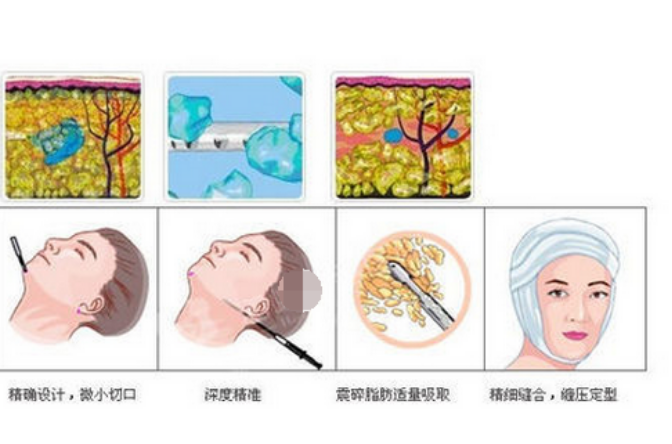脸部抽脂 脸部抽脂