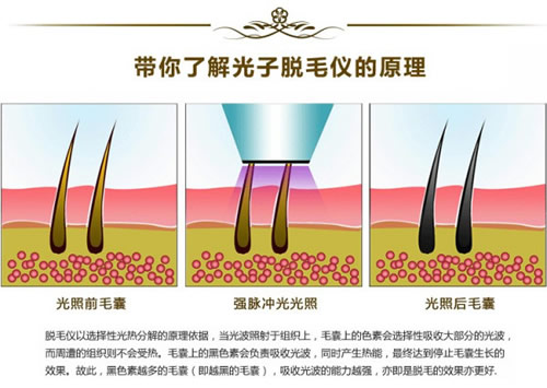 光子脱毛 光子脱毛