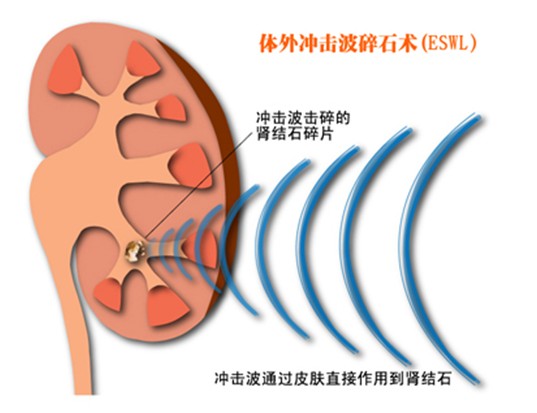 体外震波碎石术 体外震波碎石术